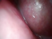 Endoscope creampie